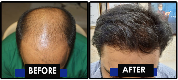 MHI Hair Transplant Result