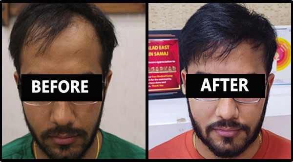 Hair Transplantation Clinic - Mumbai & Kerala, Modified Hair ...
