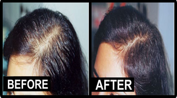 Hair Transplantation Clinic - Mumbai & Kerala, Modified Hair ...