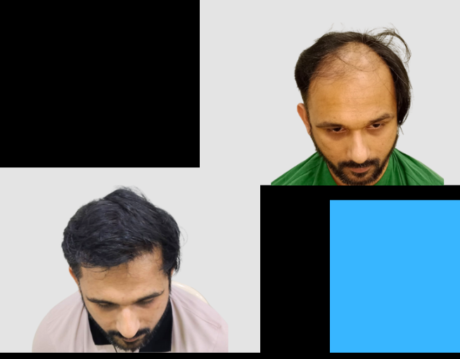 Best Hair Transplant clinic in Mumbai
