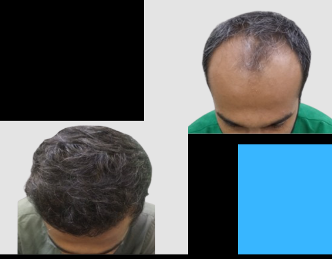 Hair Transplant Result