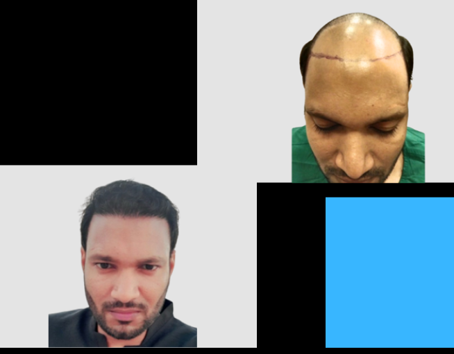 Hair Transplant clinic in Mumbai