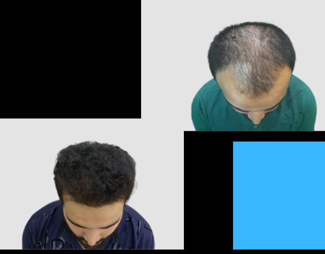 Hair Transplant cost in Mumai