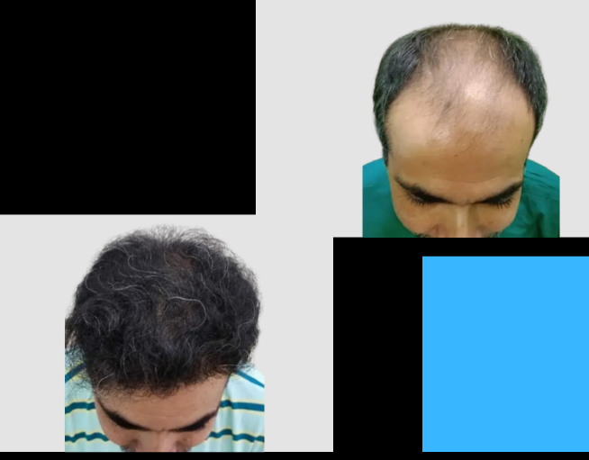Hair transplant 4500 Grafts