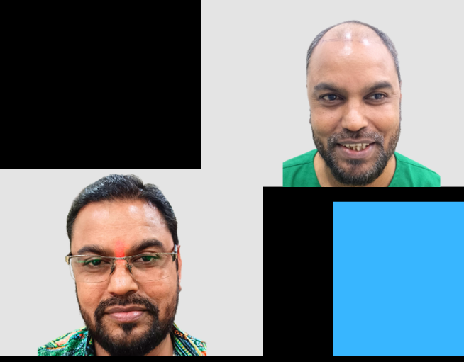 MHI hair Transplant Result