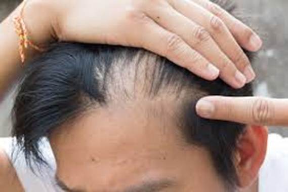 Male Pattern Baldness
