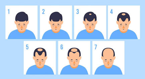 Stages of Male Baldness