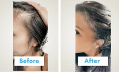 GFC Treatment Mumbai