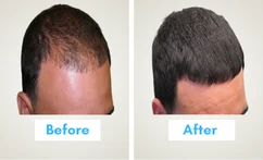 GFC Treatment Mumbai