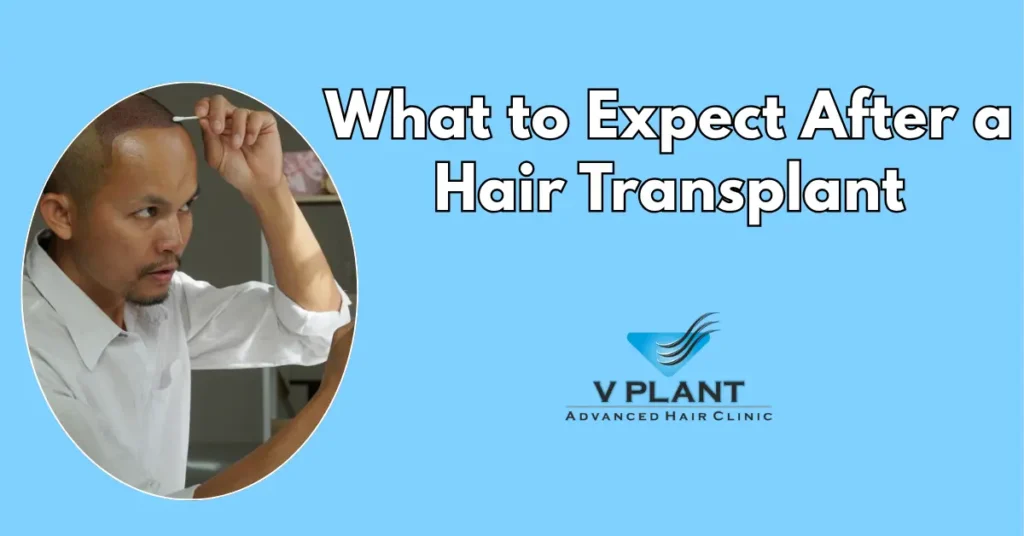 What to Expect After a Hair Transplant