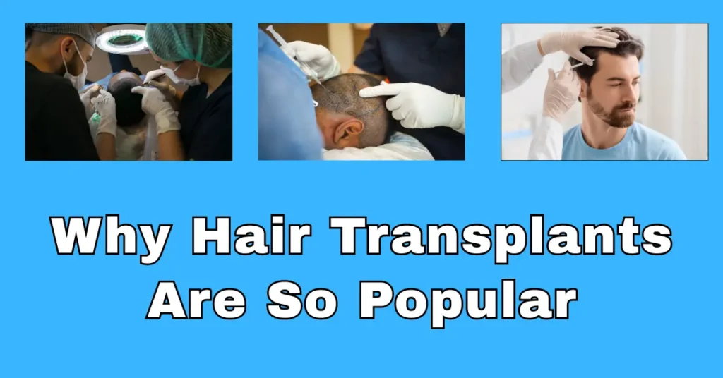 Top 5 Reasons Why Hair Transplants Are So Popular