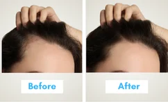 dutasteride results timeline