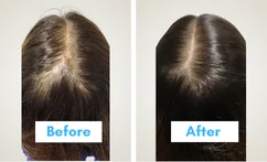 Exosome Treatment in mumbai