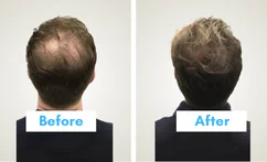 Qr678 Treatment Result