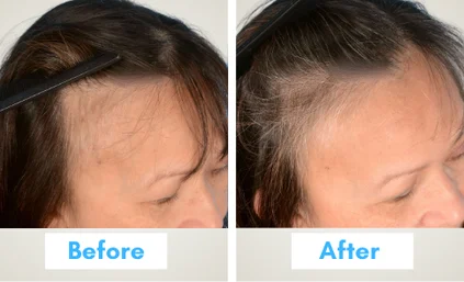 hair thread treatment cost