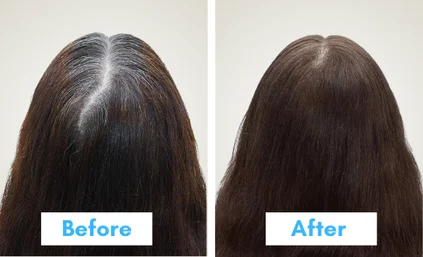 pdo threads for hair growth cost in india